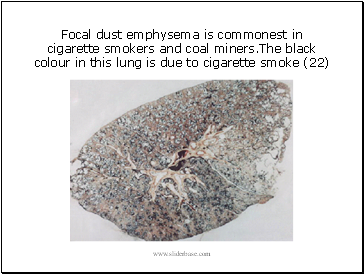 Focal dust emphysema is commonest in cigarette smokers and coal miners.The black colour in this lung is due to cigarette smoke (22)