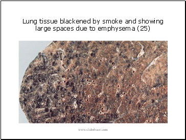 Lung tissue blackened by smoke and showing large spaces due to emphysema (25)