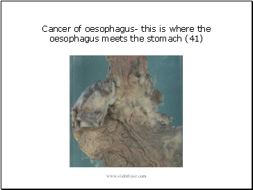 Cancer of oesophagus