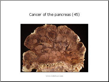 Cancer of the pancreas (45)