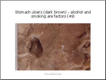 Stomach ulcers (dark brown) - alcohol and smoking are factors (49)