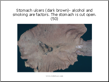 Stomach ulcers (dark brown)- alcohol and smoking are factors. The stomach is cut open. (50)