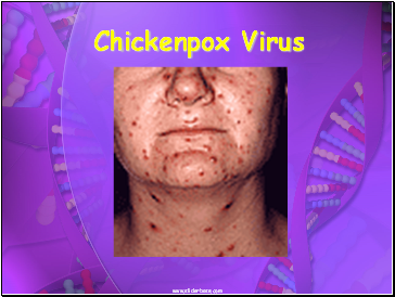 Chickenpox Virus