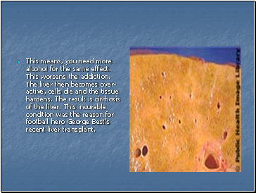 This means, you need more alcohol for the same effect. This worsens the addiction. The liver then becomes over-active, cells die and the tissue hardens. The result is cirrhosis of the liver. This incurable condition was the reason for football hero George Best's recent liver transplant.
