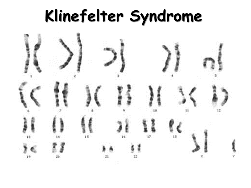 Klinefelter Syndrome Pictures