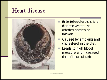 Heart disease