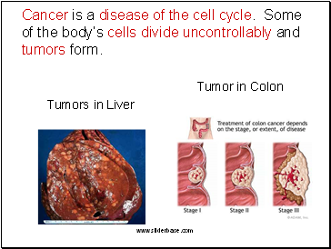 Cancer is a disease of the cell cycle. Some of the bodys cells divide uncontrollably and tumors form.