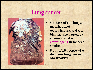 Lung cancer