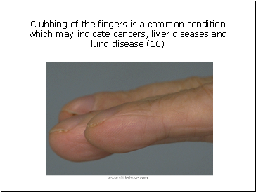 Clubbing of the fingers is a common condition which may indicate cancers, liver diseases and lung disease (16)