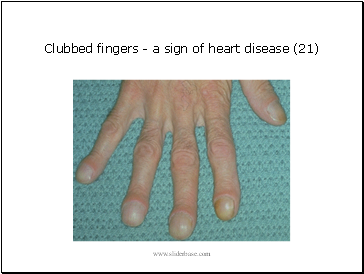 Clubbed fingers