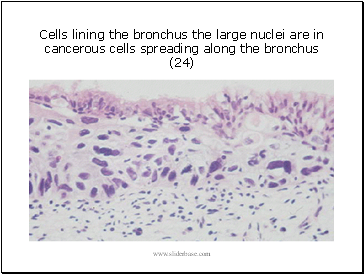 Cells lining the bronchus the large nuclei are in cancerous cells spreading along the bronchus (24)