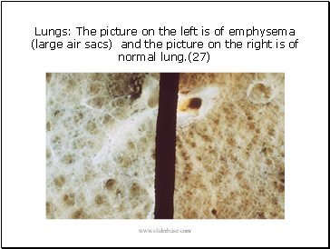 Lungs: The picture on the left is of emphysema (large air sacs) and the picture on the right is of normal lung.(27)
