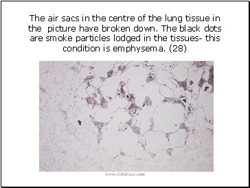 The air sacs in the centre of the lung tissue in the picture have broken down. The black dots are smoke particles lodged in the tissues- this condition is emphysema. (28)