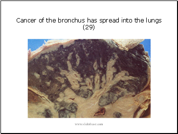 Cancer of the bronchus has spread into the lungs (29)