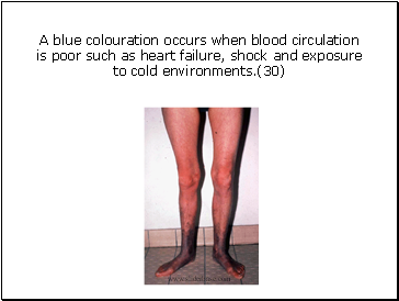 A blue colouration occurs when blood circulation is poor such as heart failure, shock and exposure to cold environments.(30)