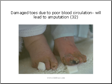Damaged toes due to poor blood circulation- will lead to amputation (32)