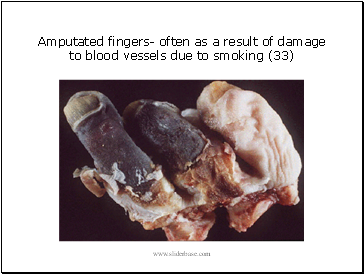 Amputated fingers- often as a result of damage to blood vessels due to smoking (33)