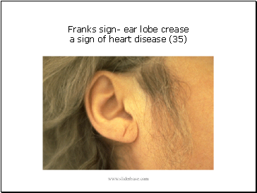 Franks sign- ear lobe crease a sign of heart disease (35)