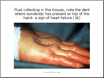 Fluid collecting in the tissues, note the dent where somebody has pressed on top of the hand- a sign of heart failure (36)