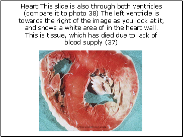 Heart:This slice is also through both ventricles (compare it to photo 38) The left ventricle is towards the right of the image as you look at it, and shows a white area of in the heart wall. This is tissue, which has died due to lack of blood supply (37)