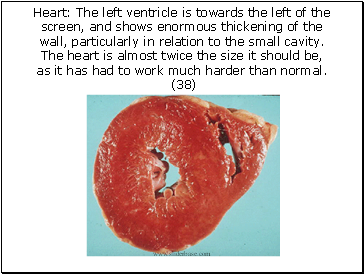 Heart: The left ventricle is towards the left of the screen, and shows enormous thickening of the wall, particularly in relation to the small cavity. The heart is almost twice the size it should be, as it has had to work much harder than normal. (38)