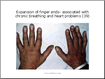 Expansion of finger ends- associated with chronic breathing and heart problems (39)