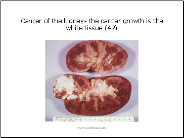 Cancer of the kidney