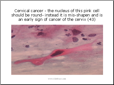 Cervical cancer - the nucleus of this pink cell should be round- instead it is mis-shapen and is an early sign of cancer of the cervix (43)