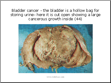 Bladder cancer