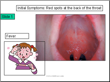 Initial Symptoms: Red spots at the back of the throat