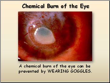 Chemical Burn of the Eye