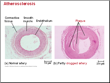 Atherosclerosis