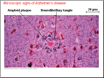 Microscopic signs of Alzheimers disease