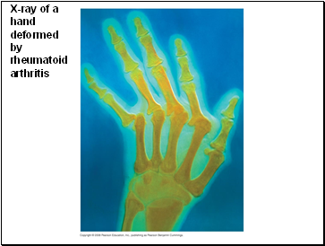 X-ray of a hand deformed by rheumatoid arthritis