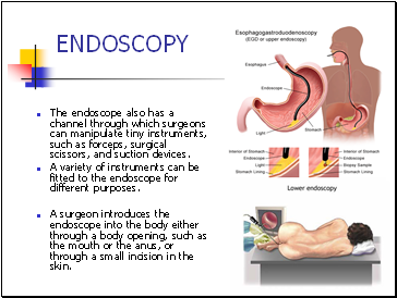 The endoscope also has a channel through which surgeons can manipulate tiny instruments, such as forceps, surgical scissors, and suction devices.
