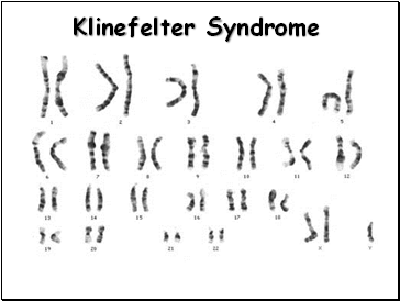 Klinefelter Syndrome