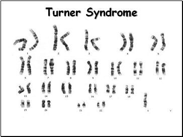 Turner Syndrome