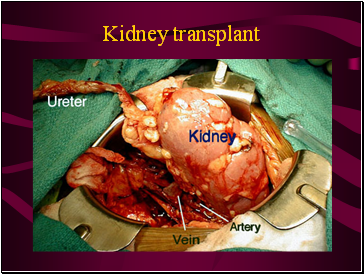 Kidney transplant