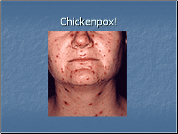Chickenpox!