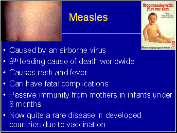 Measles