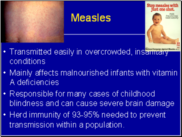 Measles