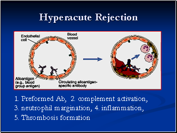 Hyperacute Rejection