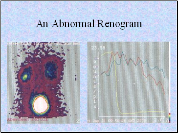 An Abnormal Renogram