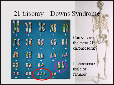 21 trisomy – Downs Syndrome