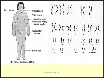 Turners syndrome