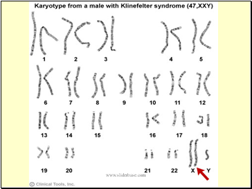 Klinefelter’s syndrome