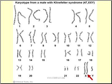 Klinefelters syndrome