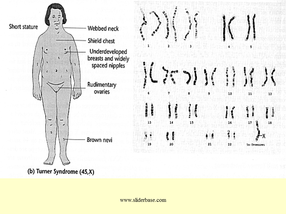 Xxy хромосома. Синдром Клайнфельтера 47 xxy. Синдром Клайнфельтера евнухоидное. Клинические признаки синдрома Клайнфельтера. Гинекомастия Клайнфельтера.