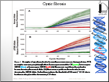 Cystic fibrosis (CF) is the most common inherited disease among Caucasian populations with an incidence of ~1 in 2500 births.(9)