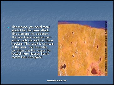 This means, you need more alcohol for the same effect. This worsens the addiction. The liver then becomes over-active, cells die and the tissue hardens. The result is cirrhosis of the liver. This incurable condition was the reason for football hero George Best's recent liver transplant.